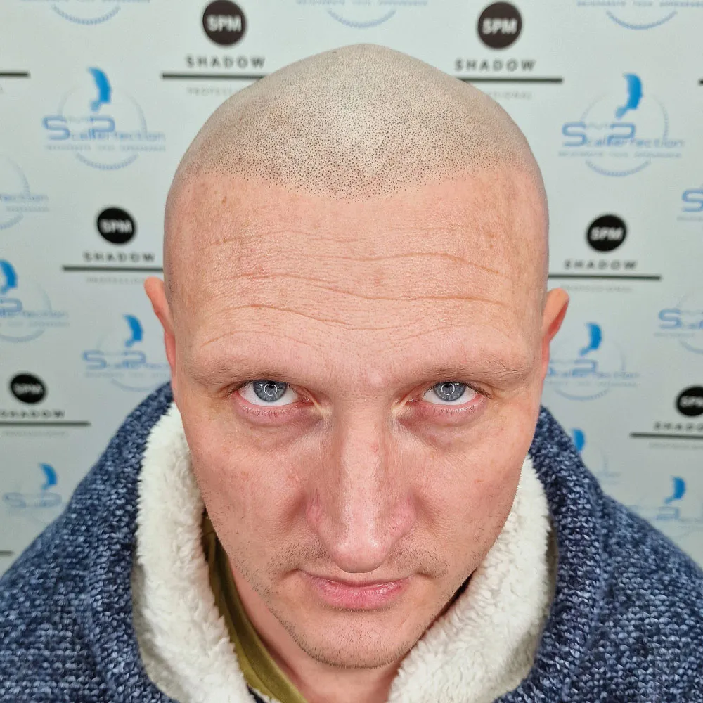 after-laser-and-new-treatment