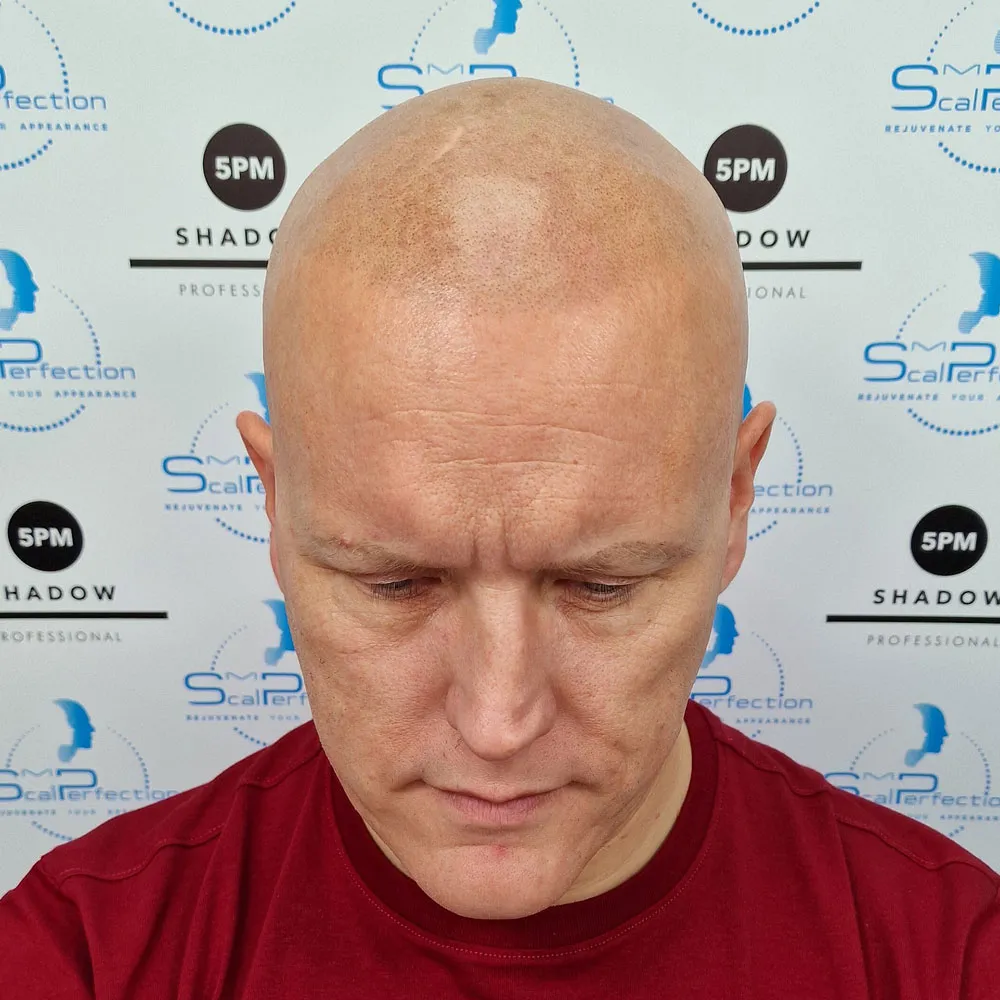 alopecia-2