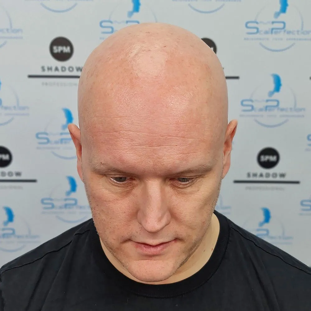 alopecia-before-1