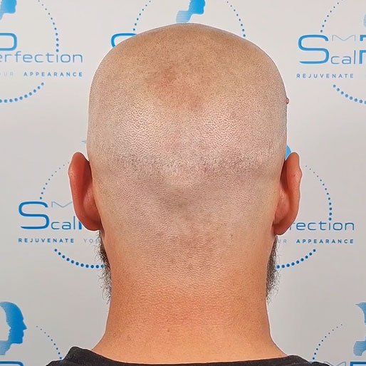 scar-after-treatment-4