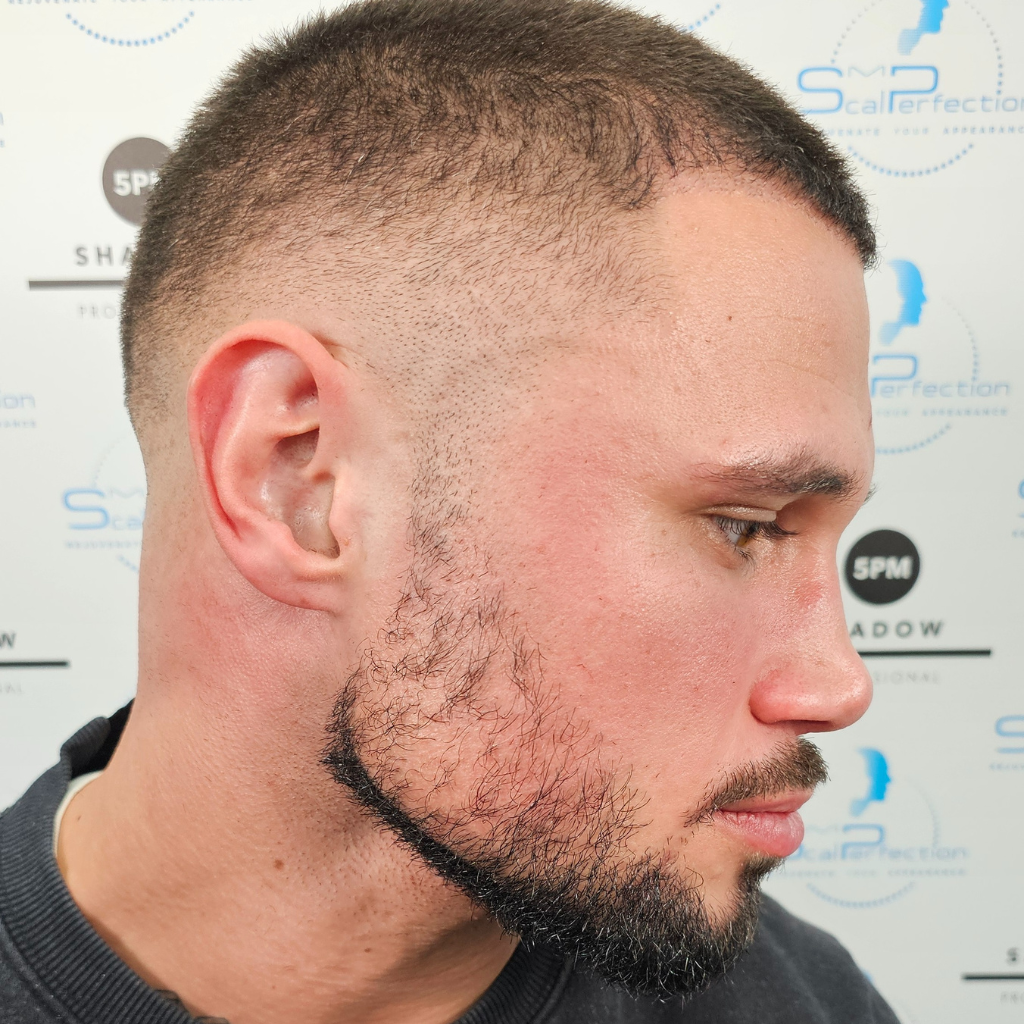 Facial Micropigmentation