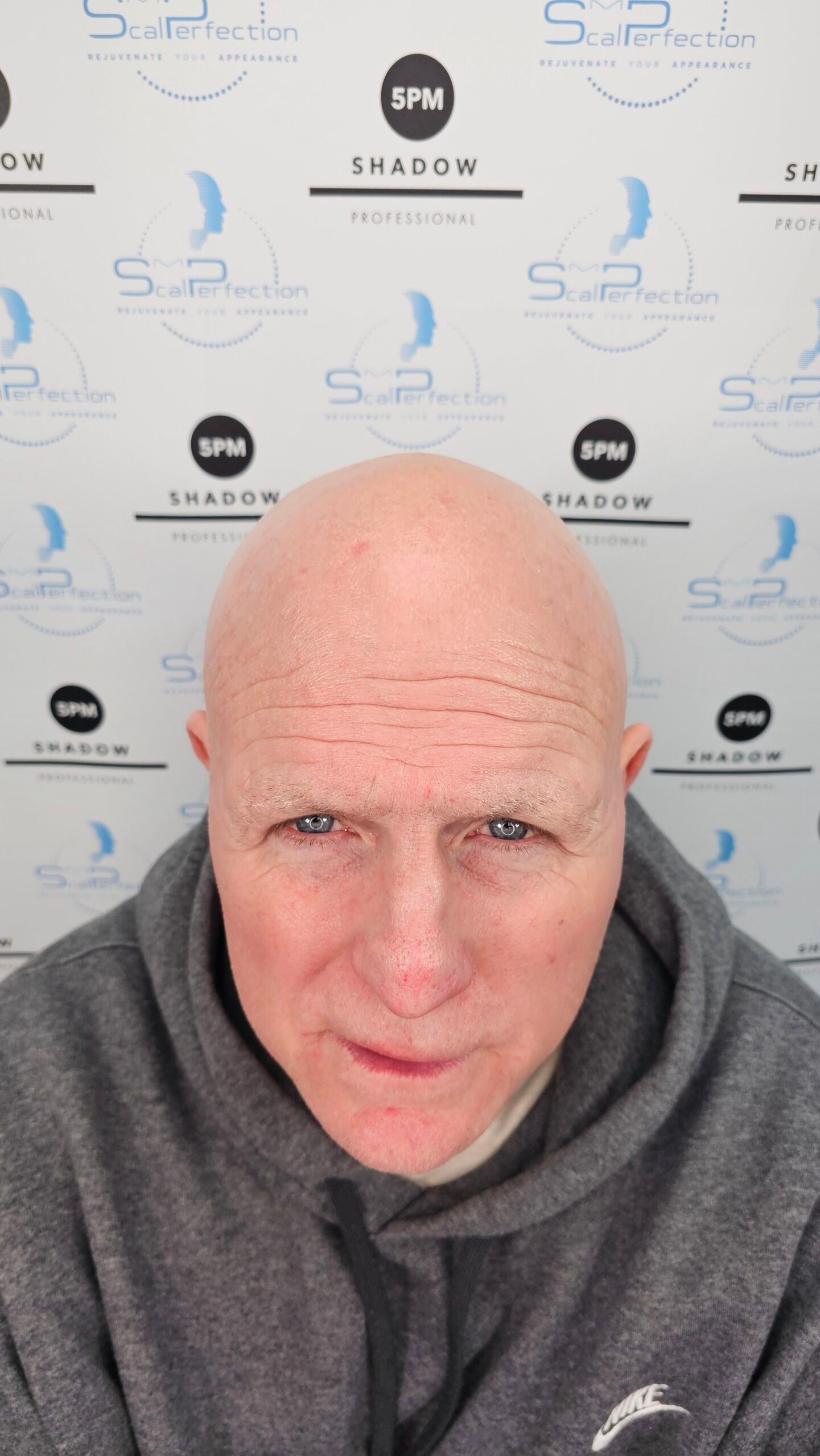 SMP Hair Thinning treatment