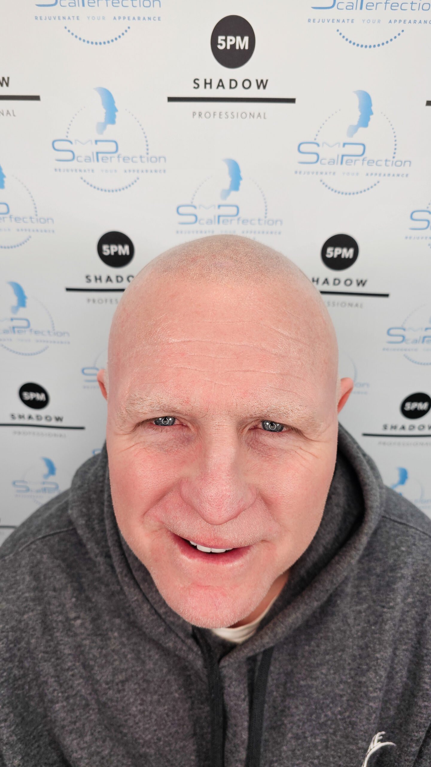 SMP Hair Thinning treatment