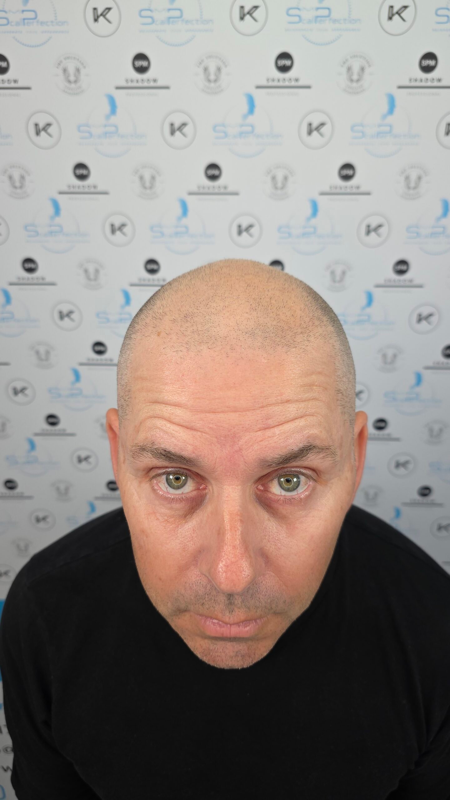 Male Pattern Baldness SMP Treatment