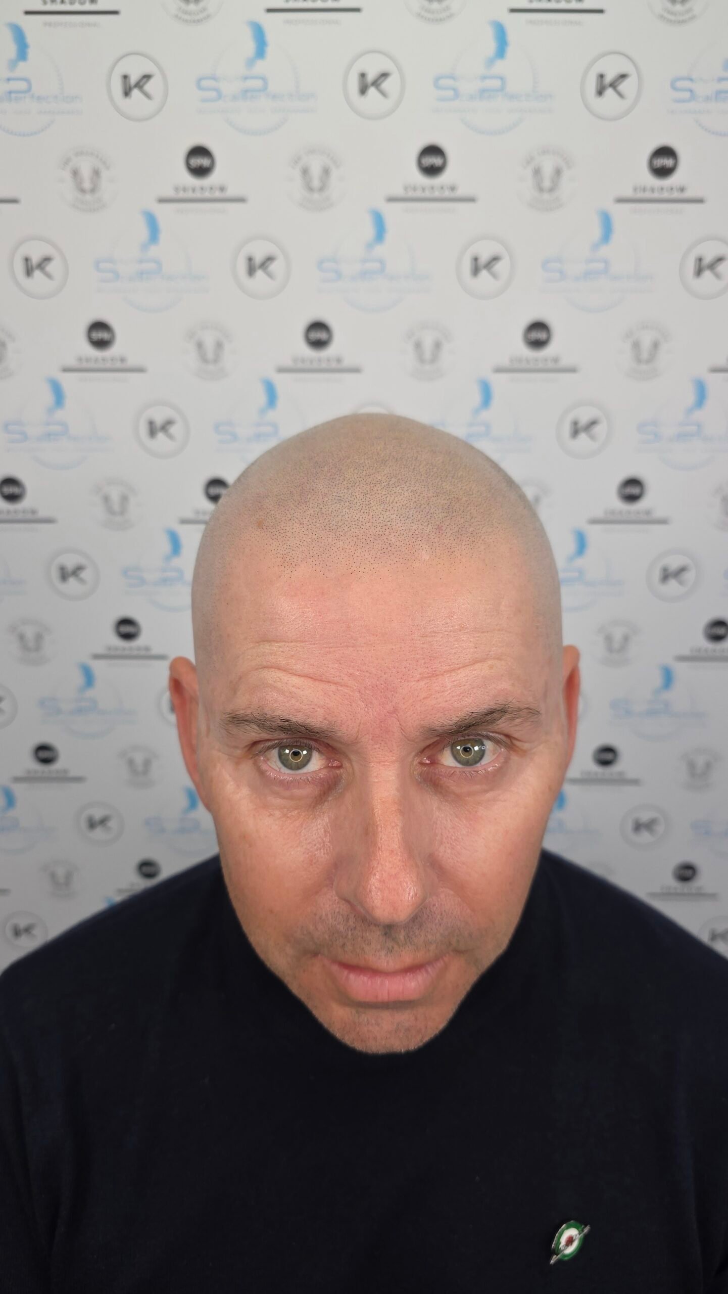 Male Pattern Baldness SMP Treatment