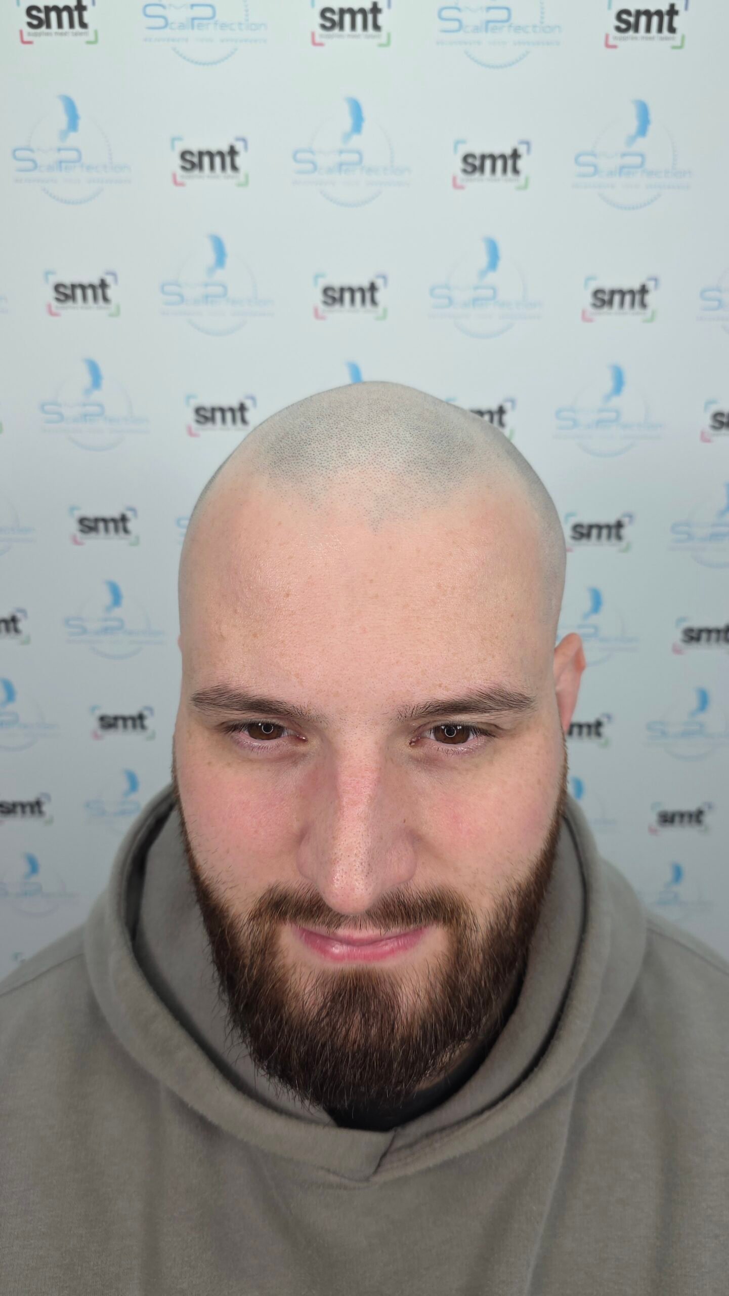 SMP for Medical Hair Loss