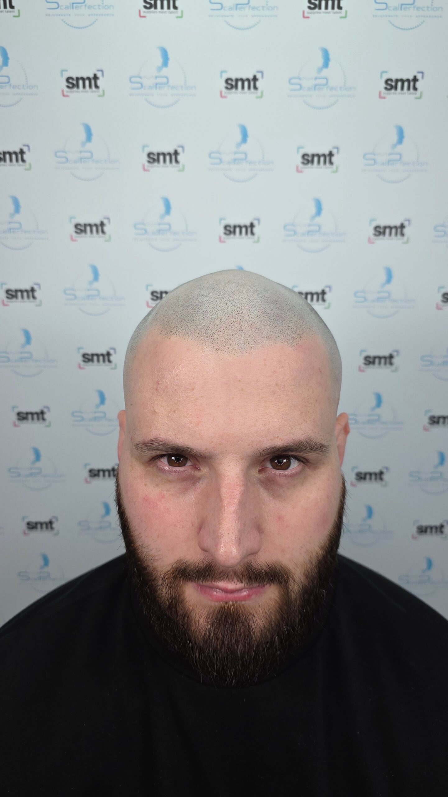 SMP for Medical Hair Loss